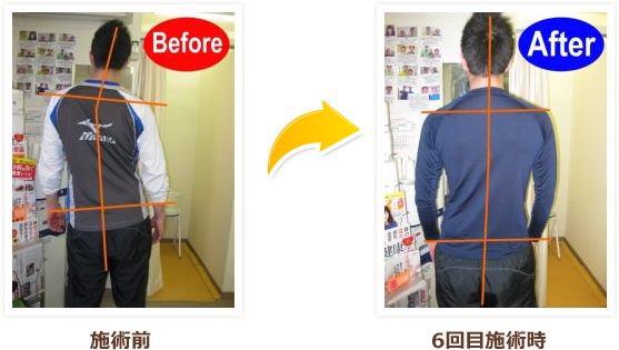 ひどい腰痛のため大きく身体が曲がっていましたが、整体を受けてから6回目には大分姿勢がまっすぐになり、痛みも半分以下に減りました。